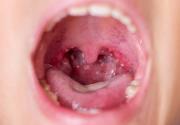 Coxsackie virusas vaikams: simptomai, gydymas, inkubacinis laikotarpis