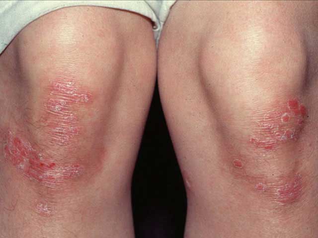 hogyan lehet elrejteni a vörös foltokat a lábán pikkelysömör kezelese hazilag