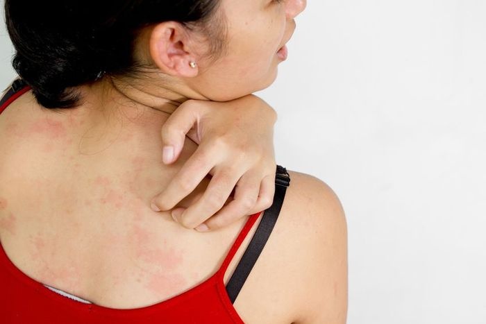 Az atópiás dermatitis miatt idegek